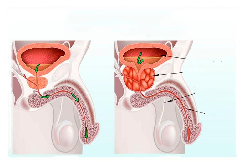 rate and inflammation of the prostate gland