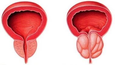 healthy prostate and inflamed prostate